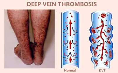 What Nurses Need to Know About Deep Vein Thrombosis (DVT)