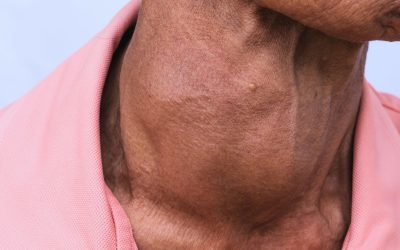 Thyroid Disorders in the Elderly